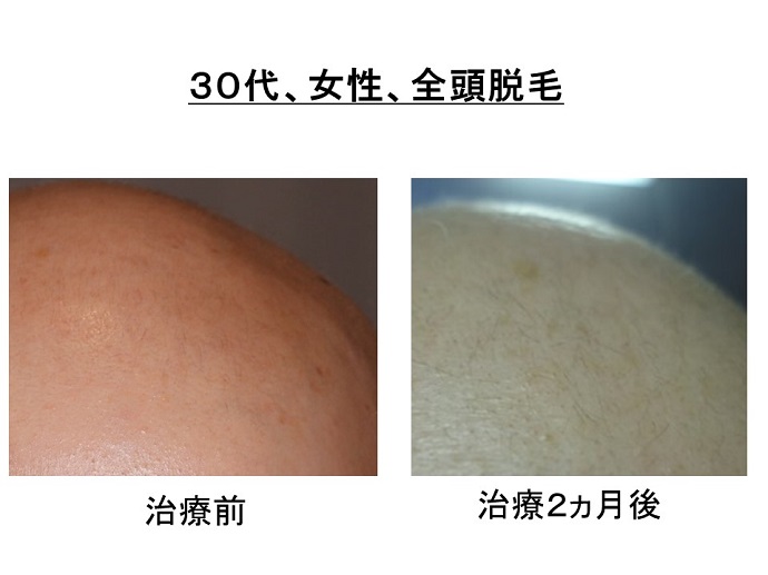 円形脱毛症　病院